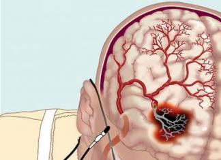 Нарушения артериального кровообращения мозга: формы, признаки, лечение Первые признаки онмк по ишемическому типу