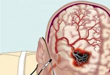 Нарушения артериального кровообращения мозга: формы, признаки, лечение Первые признаки онмк по ишемическому типу